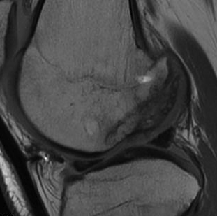 Mosaicplasty Healed OCD Lateral